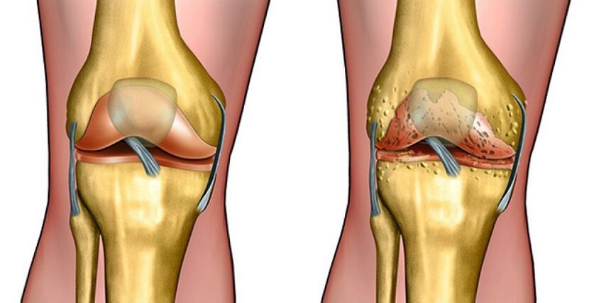 gonartroza artroza na koleno)