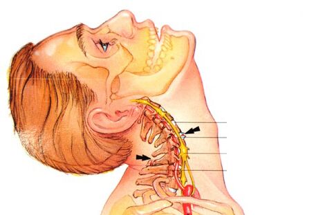 ako vyzerá osteochondróza krčnej chrbtice