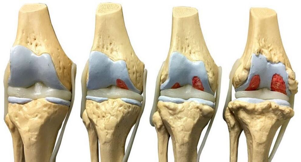 Etapy vývoja artrózy kolenného kĺbu