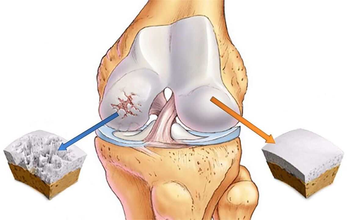 Zničenie chrupavky kolenného kĺbu s gonartrózou