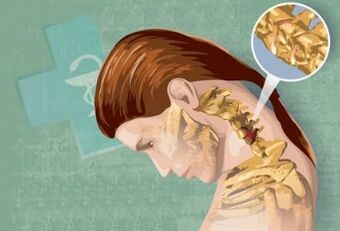 Reflexné príznaky krčnej osteochondrózy