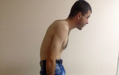 Ankylozujúca spondylitída môže v priebehu rokov spôsobiť bolesť dolnej časti chrbta