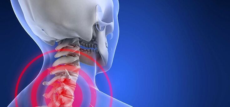 Osteochondróza krčnej chrbtice